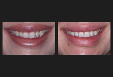 Crown Lengthening - Garden Ridge Center For Dentistry