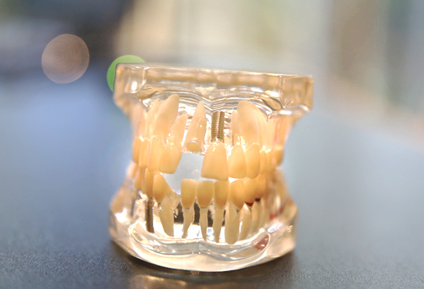 Implants - Garden Ridge Center For Dentistry