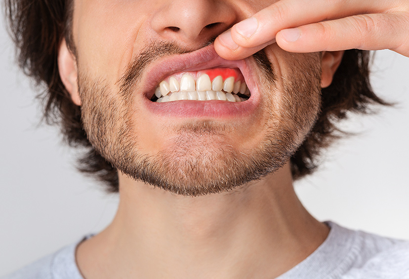 Non-Surgical Gum Treatments - Garden Ridge Center For Dentistry