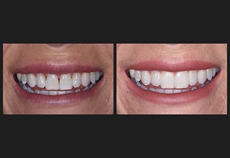 Long Lasting Results - Garden Ridge Center For Dentistry