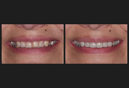 Cosmetic Uses - Garden Ridge Center For Dentistry