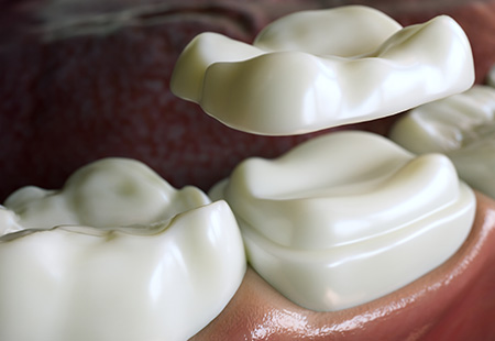 What are Sealants? - Garden Ridge Center For Dentistry