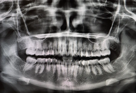 About X-Rays - Garden Ridge Center For Dentistry