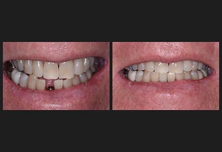 Achieving a Natural Look with Single Anterior Implants - Garden Ridge Center For Dentistry