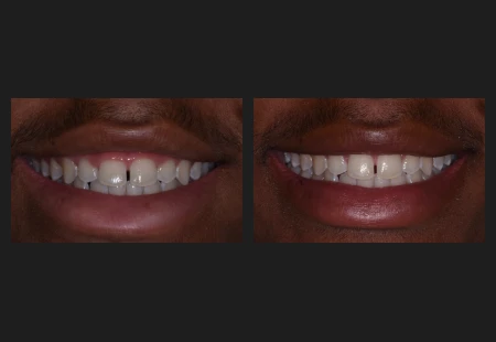 Advanced Laser Crown Lengthening Here - Garden Ridge Center For Dentistry